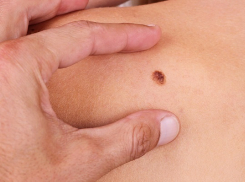 Медики Воронежской области через соцсети проводят бесплатную диагностику рака кожи