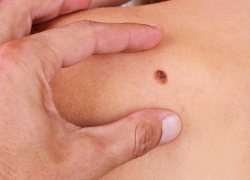 Медики Воронежской области через соцсети проводят бесплатную диагностику рака кожи