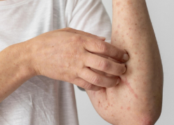 В Воронежской области резко возросла заболеваемость ветрянкой