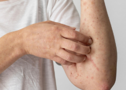 Заболеваемость ветряной оспой и корью снизилась почти в два раза в Воронежской области