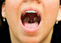 Жителей Воронежской области предупреждают о вспышке дифтерии