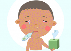 Уже  пятый случай кори выявили в Воронежской области 