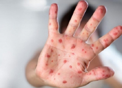 Европу охватила корь из Украины. Россия следующая?