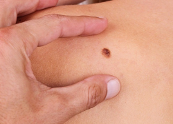 Воронежские врачи рассказали, каким онкозаболеваниям больше всего подвержены жители региона