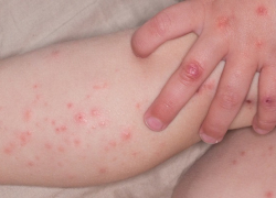 Роспотребнадзор предупреждает борисоглебцев об опасности энтеровирусных инфекций в летний период