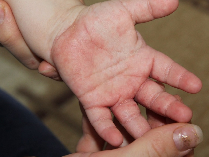 39 человек заболели чесоткой в Воронежской области с начала года