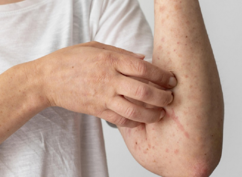 Заболеваемость ветряной оспой и корью снизилась почти в два раза в Воронежской области