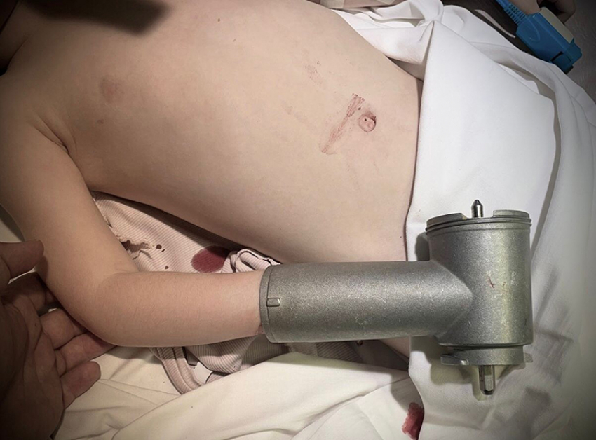 Ребенок засунул руку в мясорубку в Воронежской области